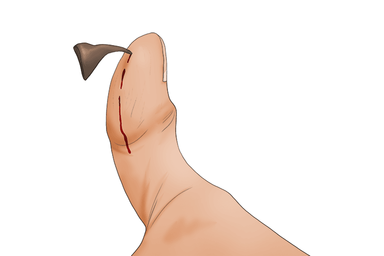 This quotation can be remembered with the single picture mnemonic of a pricked thumb. 