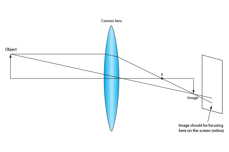 Myopia and correction