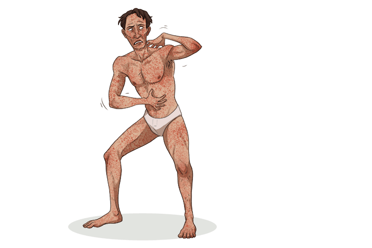 I have a rash on all (irrational) my body, the spots go on and on (never ending).